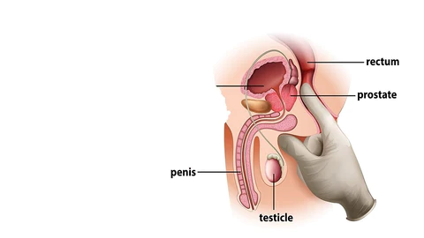 how to prostate massage for impotence